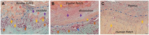 Degradation patterns of patch materials. Movat Verhoeff stained patch materials. (A) Bovine patch. Collagen fragments (yellow arrows), exudate (lilac arrow), macrophage accumulation at patch–tissue interface (blue dashed line, orange arrow). (B) Equine patch. Dissolution and edematous swelling of patch material (yellow, lilac arrows), macrophages (orange arrow) and foreign body giant cells (blue arrows) at patch–tissue interface (blue dashed line). (C) Human patch—No cell accumulation, no discernible degradation pattern at patch–tissue interface (blue dashed line).