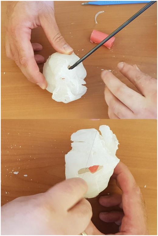 Surgeon using the 3D model of the double-outlet right ventricle heart to simulate the Rastelli procedure, with implantation of a silicone patch.