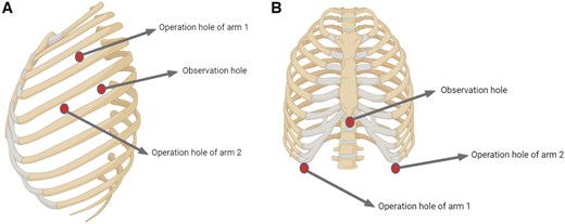 Schematic diagram of the surgical approach. (A) Lateral approach. (B) Subxiphoid approach.