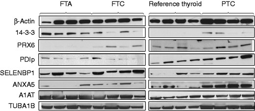 Western blots illustrating expression of the nine selected proteins in samples from each study group (reference thyroid, FTA, FTC, and PTC). β-Actin was used as control of protein loading and quality in all analyses.