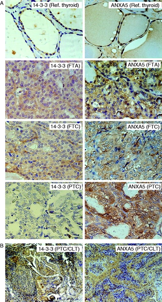 Immunohistochemical analysis of protein expression for 14-3-3 (isoforms: β/α, ε and ζ/δ) and ANXA5. (A) Photomicrographs in 40× magnification of paraffin sections where predominantly cytosolic staining is visualized for 14-3-3 and ANXA5 in the different sample groups. (B) Photomicrographs in 10× magnification for 14-3-3 and 16× magnification for ANXA5 analysis on paraffin sections of PTC with CLT visualizing non-stained lymphocytes together with positively stained tumor cells.