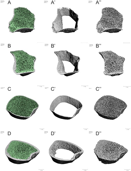 Representative images depicting bone microarchitecture of the non-dominant radius and distal tibia of a CO AGHD patient and a healthy control. Left panel show the whole bone microarchitecture the non-dominant radius in CO AGHD patient (A) and healthy control (B), distal tibia in CO AGHD patient (C) and healthy control (D). Middle panel highlights decreased cortical thickness in both radius and distal tibia in a patient with CO AGHD (A′ and C′) compared with healthy control (B′ and D′). Right panel shows deficient trabecular bone in both radius and distal tibia in a CO AGHD patient (A″ and C″) compared with healthy control (B″ and D″).