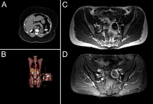 Computed tomographic scan showing bilateral macronodular adrenal hyperplasia (Patient 1, A); PET-CT revealing a left-sided ovarian mass (Patient 2, B); MRI scan revealing a cystic tumor on the left ovary (C) with peripheral contrast media enhancement (Patient 3, D).