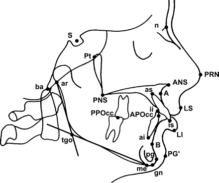 Cephalometric landmarks. Hard tissue: nasion (n) – the point where the midsagittal plane intersects the most anterior point of the nasofrontal suture; sella turcica (S) – the centre of sella turcica; basion (ba) – the most inferior posterior point in the sagittal plane on the anteior rim of the foramen magnum; articulare (ar) – the point of intersection of the dorsal contours of processus articularis mandibulae and os temporale; pterygoid point (Pt) – most posterior point on the outline of the pterygopalatine fossa; anterior nasal spine (ANS) – the tip of the anterior nasal spine as seen on the radiograph in norma laterali; posterior nasal spine (PNS) – most posterior point on the contour of the bony palate; point A (A) – the deepest point on the contour of the alveolar projection, between the spinal point and prosthion; point B (B) – the deepest midline point on the mandible between infradentale and pogonion; incision superior (is) – mid-point on the incisal edge of the most prominent upper central incisor; incision inferior (ii) – the incisal point of the most prominent medial mandibular incisor; upper incisor apex (as) – the root apex of the most prominent upper incisor; lower incisor apex (ai) – the root apex of the most prominent lower incisor; anterior occlusal point (APOcc) – the mid-point of the incisor overbite in occlusion; posterior occlusal point (PPOcc) – the most distal point of the contact between the most posterior molar in occlusion; pogonion (pg) – the most anterior point on the symphisis of the mandible; menton (me) – the lowest point of the contour of the mandibular symphisis; gonion (tgo) – intersection between mandibular line (ML) and ramus line; gnathion (gn) – most downward and forward point on the symphisis. Soft tissue: pronasale (PRN) – the most prominent or anterior point of the nose tip; laberale superius (LS) – the most prominent point located on the vermilion border of the upper lip in the mid-sagittal plane; laberale inferius (LI) – the most prominent point located on the vermilion border of the lower lip in the mid-sagittal plane; soft tissue pogonion (PG′) – the most prominent or anterior point on the soft tissue chin in the mid-sagittal plane.