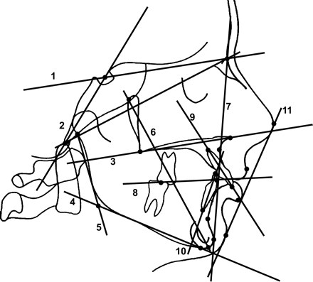 Reference lines: 1, nasion–sella line; 2, sella–basion line; 3, nasal line; 4, mandibular line; 5, tangent of mandibular ramus ascendens; 6, facial axis; 7, nasion–pogonion line; 8, occlusal line; 9, long axis of the upper incisors; 10, long axis of the lower incisors; 11, Ricketts'E line.