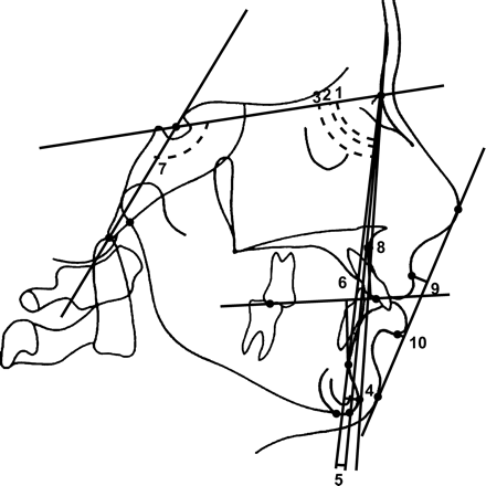 Skeletal sagittal and soft tissue measurements. Maxillary prognathism: 1. SNA (°); mandibular prognathism: 2. SNB (°); chin prognathism: 3. SNpg (°); 4. pg ⊥ NB (mm); jaw relationship: 5. ANB (°); 6. Wits appraisal (mm); inclination of cranial base: 7. NSL – ba (°); facial convexity: 8. A ⊥ N–pg (mm); 9. LS ⊥ EL (mm); 10. LI ⊥ EL (mm).