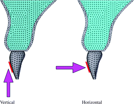 Loading direction. Distal surface view. An area of 3.3 × 4.8 mm was fixed as the loaded portion assuming a bracket base. Experimental orthodontic forces of 2N in the intrusive or lingual direction to the tooth axis were applied to the bracket base area.