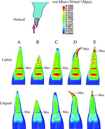 Stress distribution on the maxillary central incisor when experimental orthodontic forces were applied in an intrusive direction to the tooth axis. (Labial and lingual surface view.) Red = 0.3 MPa or more; blue = 0.05 or less.