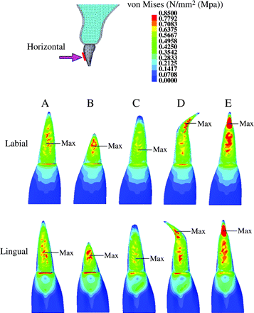 Stress distribution on the maxillary central incisor, when the experimental orthodontic forces were applied in a lingual direction to the tooth axis. (Labial and lingual surface view.) Red = 0.7 MPa or more; blue = 0.1 MPa or less.