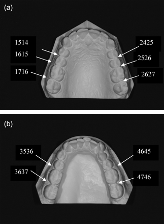 effect of constant height bracket placement on marginal ridge levelling ...