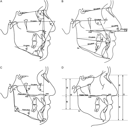 (A-C) Measurements obtained from the lateral cephalogram. Angular 1. SNA, 2. SNB, 3. ANB, 4. FMA, 5. FMIA, 6. IMPA, 7. U1-FH, 8. U1-L1, 9. Occlusal-FH, 10. GoGn-SN, 11. SN-palatal, 12. FH-palatal, 13. facial angle, 14. Y-axis, 15. gonial angle, 16. palatal-mandibular plane angle. (D) Linear 1. N-M: total anterior face height, 2. N-ANS: upper anterior face height, 3. ANS-M: lower anterior face height, 4. S-Go: total posterior face height, 5. S-PNS: upper posterior face height, 6. PNS-Go: lower posterior face height.
