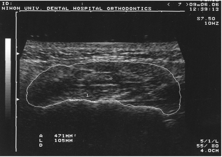 Cross-sectional ultrasound image of the masseter muscle measured using electronic cursors to instantaneously calculate the cross-sectional area.
