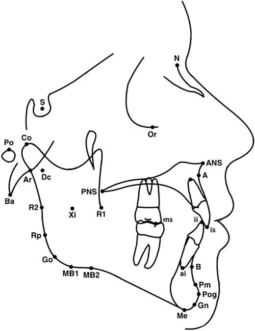 Cephalometric landmarks used in the study. S, Sella - the midpoint of sella turcica; N, Nasion - the extreme anterior point of the frontonasal suture; Ba, Basion - the most anterior-inferior point on the margin of the foramen magnum; A, point A - the deepest point in the curvature of the maxillary alveolar process; B, point B - the deepest point in the curvature of the mandibular alveolar process; ANS, point ANS - the tip of the anterior nasal spine; PNS, point PNS - the tip of the posterior nasal spine; Co, Condylion - the most posterior superior point of the condyle; Ar, Articulare - the point at the junction of the posterior border of the ramus and the inferior border of the posterior cranial base; Rp, ramus posterior point - the most prominent postero-superior point at the angle of the mandible on the posterior ramus; R1, ramus point 1 - the most concave point on the interior of the ramus; R2, ramus point 2 - the most convex point on the exterior border of the ramus along the vertical; Pog, Pogonion - the most anterior point of the chin; Me, Menton - the most inferior point of the chin; Go, Gonion - the midpoint of the mandibular angle between ramus and the mandibular corpus; MB1, inferior border point - the most convex point along the inferior border of the ramus; MB2, antegonial notch: the highest point of the notch of the lower border of the body of the mandible; Gn, Gnathion - the midpoint between Pog and Me on the bony chin; Xi, Xi point - the point located at the geometrical center of the ramus; Dc; Dc point - the point representing the center of the neck of the condyle on the Ba-N line; Pm, protuberance menti - the point at which the shape of symphysis mentalis changes from convex to concave; ai, apex inferior - the root apex of the most anterior mandibular central incisor; is, incision superior - the incisal tip of the most anterior maxillary central incisor; ii, incision inferior - the incisal tip of the most anterior mandibular central incisor; ms, molar superior - tip of the mesial buccal cusp of the mandibular first molar; Po, Porion - midpoint on upper contour of external auditory canal; Or, Orbitale - deepest point on infraorbital margin.