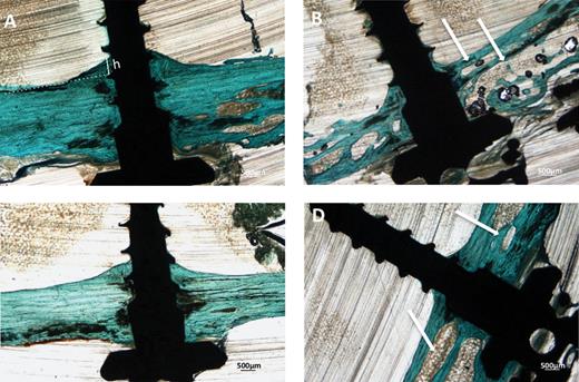Histological microphotographs of MA (A, B) and SAE (C, D) miniscrews in the absence (A, C) or after mechanical loading (B, D). Samples were stained by Masson’s trichrome. Magnification = ×2. Endosteal bone formation is indicated as h. A dramatic increase in cortical porosity can be observed around loaded miniscrews (white arrows).