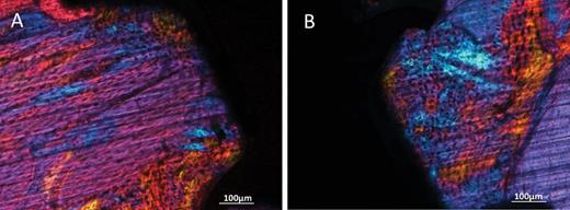 Polarised light microphotographs of peri-implant bone of MA (A) and SAE (B) miniscrews. Magnification = ×2.