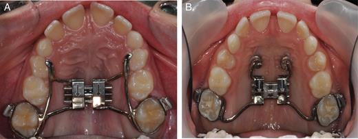 (a) Tooth-borne (TB) RME. (b) Tooth-bone-borne (TBB) RME.