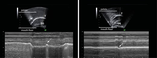 B- and M- mode tongue ultrasonogram with the ultrasound probe’s centre line set through the tip of the tongue. The white arrow shows an upward movement of the tongue tip and the genioglossus muscle in the M-mode image in Fig. 1a, which is characteristic of the somatic swallowing pattern. A downward movement of the tongue tip and the genioglossus muscle is shown by the white arrow in Fig. 1b, which is characteristic of the distinctive visceral swallowing pattern. T—tongue tip, GG—genioglossus muscle.