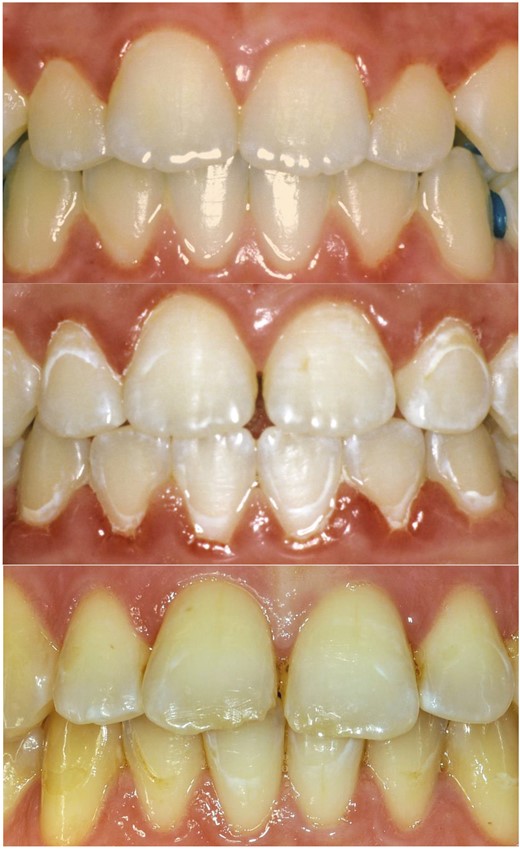 Case presentation: Teeth 12-22 and 32-42 affected at T1 and adequately visible/rateable at T0, T1, T2 and T3.