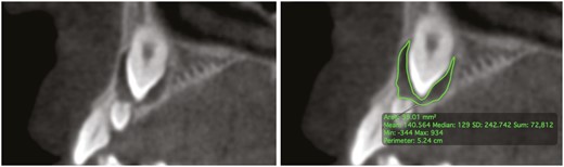 Segmentation of the dental follicle of the maxillary impacted canine using OsiriX DICOM Viewer in the sagittal view of the CBCT. This tracing method was manually repeated and refined for each slice of the DICOM containing the dental follicle.