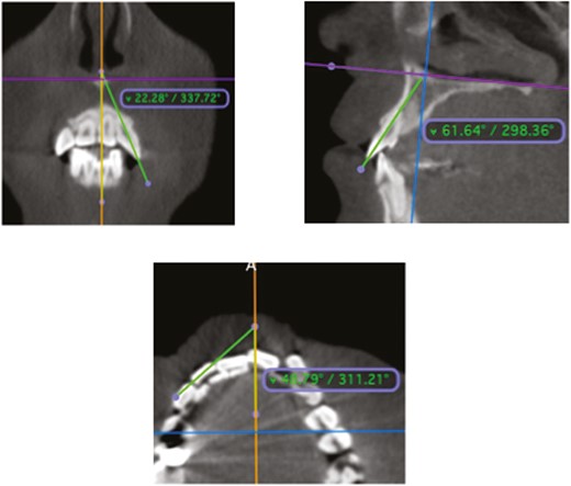 Multiplanar reconstruction views demonstrate the lateral incisor’s angular measurements. (a) Mesiodistal tip, (b) buccolingual inclination, and (c) mesiodistal rotation.