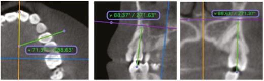 Multiplanar reconstruction views demonstrating the angular measurements of the first premolar. (a) Mesiodistal tip, (b) buccolingual inclination, and (c) mesiodistal rotation.
