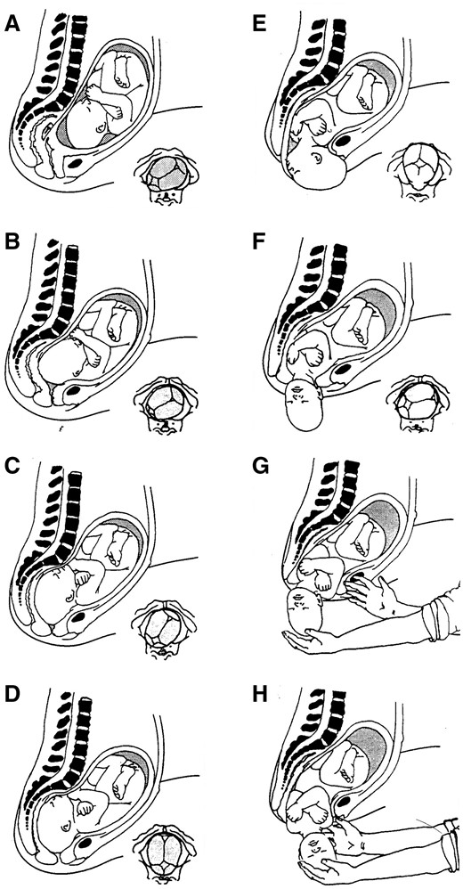 The passage of the human neonate through the maternal birth canal. Each panel is a sagittal section through the body of a mother squatting during labor. The maternal pelvic skeletal elements (pubic bone, sacrum and vertebrae) are shown in black (other parts of the bony skeleton are not visible in this midline view). In the lower right corner of each panel is a ‘midwife’s-eye’ view of the neonatal head as it rotates within and emerges from the birth canal. Athough this mechanism of labor is not the only way that human neonates emerge through the birth canal it is by far the most common and is associated with the lowest risks to both mothers and their babies