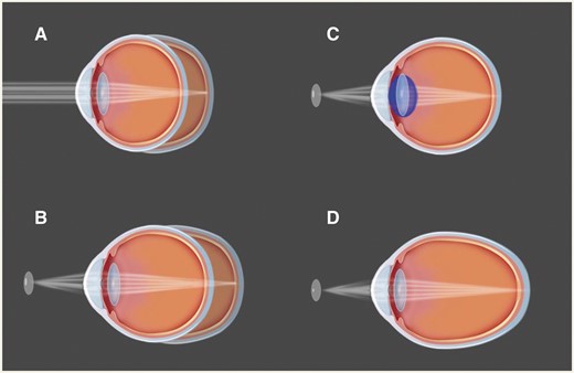 Emmetropization, myopia, and accommodation. (A) Human infants are born hyperopic, and then later on, their eyes exhibit gradual development relying on the visual inputs, eventually reaching emmetropization. (B) When a closer object is viewed, the image is focused behind the retina. The axial elongation of the eyeball is triggered and myopia happens. (C) For emmetropic eye, a closer object should be focused under the help of accommodation by increasing the optical power of the lens. (D) For myopic eye, closer objects can be focused without any accommodations