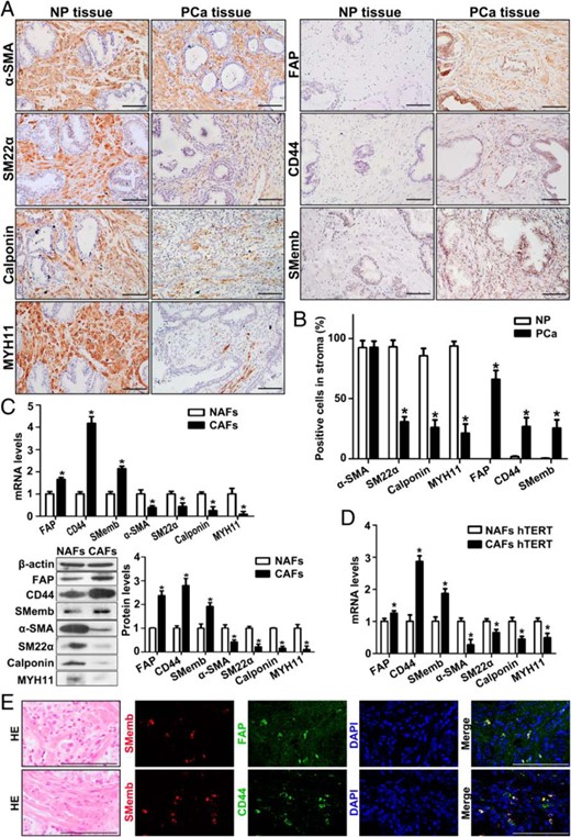 Increased SMemb-positive stem-like cells and decreased SMCs in PCa stroma. A, IHC analysis of SM differentiation markers and FAP, CD44, and SMemb expression in human NP and PCa tissue. Bar, 100 μm. B, Mean (SE) percentage of stromal area per high-power field (n = 9) stained positive for FAP, CD44, Smemb, and SM differentiation markers in NP (n = 6) and PCa (n = 7) tissue. *, P < .05, PCa vs NP. C, Real-time RT-PCR and Western blot analysis of FAP, CD44, Smemb, and SM differentiation markers expression at mRNA (upper panel) and protein level (lower panel) in primary NAFs and CAFs. ImageJ software (National Institutes of Health) was used for densitometric quantification of proteins. Results are presented as mean ± SD (n = 3). *, P < .05, CAFs vs NAFs. D, Real-time RT-PCR analysis of FAP, CD44, Smemb, and SM differentiation markers expression in hTERT-immortalized NAFs and CAFs. Results are presented as mean ± SD (n = 3). *, P < .05, CAFs vs NAFs. E, Serial sections from each group were analyzed by HE staining and double-IF staining of SMemb with FAP or SMemb with CD44 in PCa tissue. Cell nuclei were counterstained with DAPI (blue). Bar, 100 μm.