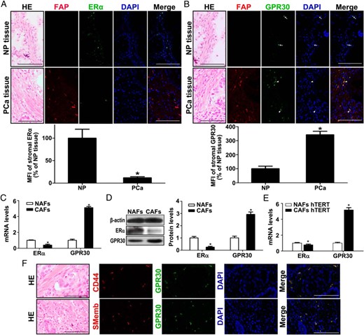 Prostate CAFs show high GPR30 but low ERα expression. A, Serial sections from each group were analyzed by HE staining and double-IF staining of FAP with ERα in NP and PCa tissue (upper panel) and mean of florescent intensity of the images (MFI) of stromal ERα (lower panel) (n = 6). Cell nuclei were counterstained with DAPI (blue). Bar, 100 μm. *, P < .05, PCa vs NP. B, Serial sections from each group were analyzed by HE staining and double-IF staining of FAP with GPR30 in NP and PCa tissue (upper panel) and MFI of stromal GPR30 (lower panel). Bar, 100 μm. *, P < .05, PCa vs NP. C and D, Real-time RT-PCR and Western blot analysis of ERα and GPR30 expression at mRNA (C) and protein level (D) in primary NAFs and CAFs. Results are presented as mean ± SD (n = 3). *, P < .0,5 CAFs vs NAFs. E, Real-time RT-PCR analysis of ERα and GPR30 expression in hTERT-immortalized NAFs and CAFs. Results are presented as mean ± SD (n = 3). *, P < .05, CAFs vs NAFs. F, Serial sections from each group were analyzed by HE staining and double-IF staining of CD44 with GPR30 and SMemb with GPR30 in PCa tissue. Bar, 100 μm.
