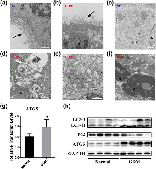 Placenta ultrastructure and autophagy expression in NP and patients with GDM. (a) Continuous, uniform microvilli and oval mitochondria in NP. (b) Collapsed and decreased apical microvilli (black arrow) and multiple vacuoles in GDM. (c) Integrated and legible organelles such as mitochondria (asterisks), endoplasmic reticulum (number signs), and dictyosomes (or golgiosomes; black arrowheads) were present, but the autophagosome was not seen in NP. (d) Autophagic vacuoles (white arrows) with double membrane (white arrowheads) in GDM. The inner membrane remnants (circumflex) of autophagosome and partially degraded mitochondria were seen in the autophagolysosome (green dotted line). Also, degraded subcellular organelles (i) and membrane remnants (ii) and a mitochondrion with obvious cristae (iii) were found in these autophagolysosomes. (e and f) Autophagic vacuoles in GDM and a cup-shaped phagophore (red arrow) and swollen mitochondria (green arrow) were detected. (g) Relative expression of ATG5 measured using quantitative polymerase chain reaction in the placenta of NP and GDM. *P < 0.05. (h) Representative Western blotting bands of autophagy markers LC3-I, LC3-II, p62, ATG5, and glyceraldehyde 3-phosphate dehydrogenase (GAPDH). (a, b, and d) Scale bars = 1 μm. (c, e, and f) Scale bars = 500 nm. L, lysosome; N, nucleus.