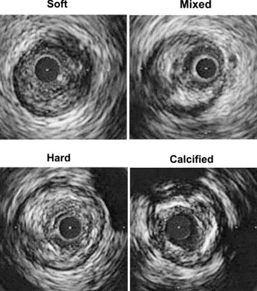 Plaque morphology categorized by IVUS. We classified the plaques into ...