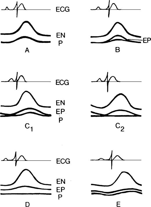 Horowitz classification of pericardial effusions.43 Type A: No effusion; Type B: Separation of epicardium and pericardium (3–16 ml); Type C 1: Systolic and diastolic separation of epicardium and pericardium (small effusion \batchmode \documentclass[fleqn,10pt,legalpaper]{article} \usepackage{amssymb} \usepackage{amsfonts} \usepackage{amsmath} \pagestyle{empty} \begin{document} \(>\) \end{document}16 ml); Type C 2: Systolic and diastolic separation of epicardium and pericardium with attenuated pericardial motion; Type D: Pronounced separation of epicardium and pericardium with large echo-free space; Type E: Pericardial thickening (\batchmode \documentclass[fleqn,10pt,legalpaper]{article} \usepackage{amssymb} \usepackage{amsfonts} \usepackage{amsmath} \pagestyle{empty} \begin{document} \(>\) \end{document}4 mm). Copyrights American Heart Association.