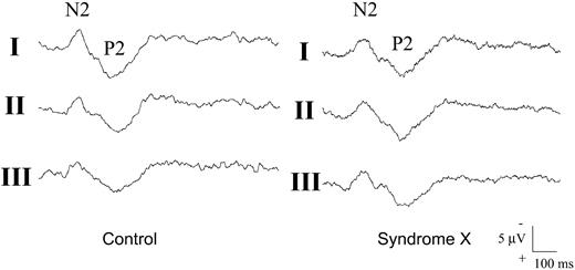 Figure 2 Examples of the change in N2/P2 amplitude during the three sequences of laser stimuli applied to the chest skin in a healthy control subject and in a SX patient. The N2/P2 potential amplitude decreases progressively from the first (I) to the third (III) sequence of stimuli in the control subject, but remains unchanged in the SX patient.