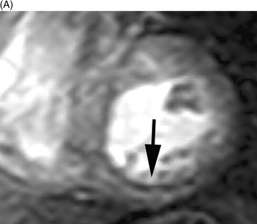 Figure 1 First-pass perfusion images in patients 5 days after AMI indicating (A) subendocardial perfusion defect (score 2) in the inferior wall and (B) a severe perfusion defect in the interventricular septum extending beyond the subendocardium (score 3).