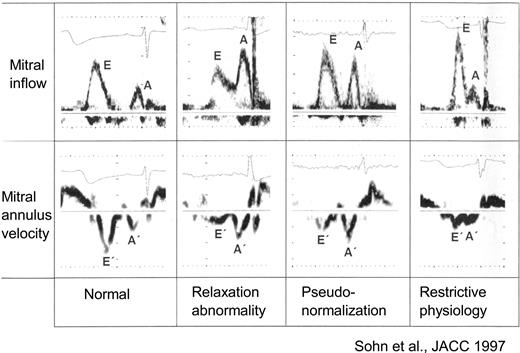 Figure 3 The three filling patterns ‘impaired relaxation’, ‘pseudonormalised filling’, and ‘restrictive filling’ represent mild, moderate, and severe diastolic dysfunction, respectively.37