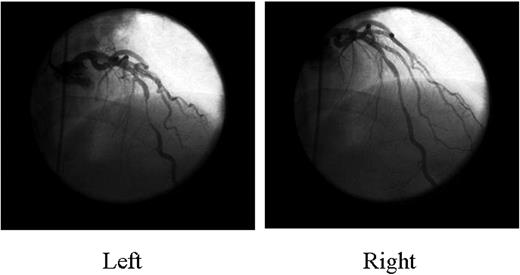 Figure 1 Coronary angiography shows systolic compression of the mid LAD artery (myocardial bridging) (left) that almost completely resolved in diastole (right).