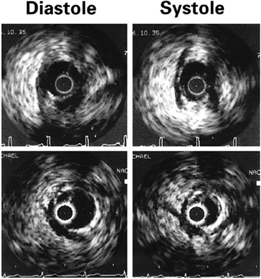 Figure 2 Intravascular ultrasonographic imaging of myocardial bridging during diastole and systole. A half-moon-shaped, echolucent area surrounding the bridge is seen during the entire cardiac cycle. The distance between two calibration marks is 1 mm. (From Ge et al.67 By permission of the publisher.)