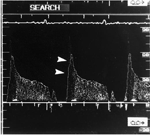 Figure 3 Characteristic flow pattern in the bridge segment demonstrated by intracoronary Doppler imaging. A steep rise in the flow velocity at early diastole is followed by a sharp deceleration and subsequent plateau (‘fingertip’ phenomenon, arrowheads). No anterograde flow is observed during systole. (From Ge et al.67 By permission of the publisher.)