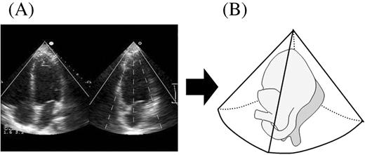 Figure 1 Acquisition of full volume volumetric data sets by new RT3DE. (A) After visualizing reference images, full volume data sets of LV were acquired; four conical subvolumes of ∼20°×80° were scanned during seven consecutive heart beats. (B) These four subvolumes were automatically integrated and entire pyramidal data sets of ∼80°×80° were obtained for acquisition of the full LV volume.