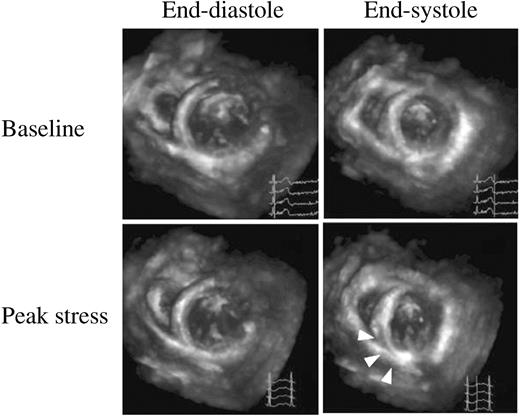 Figure 3 Mid-short-axis views by RT3DE in a patient with myocardial ischaemia; upper series of panels are images at baseline and lower series of panels are those at peak stress. At baseline, LV wall myocardium thickens normally from diastole (left side) to systole (right side). At peak stress, arrows point to the LV abnormality in the inferior wall.