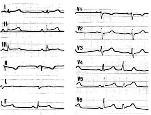 Figure 2 Basal 12-lead ECG tracing in Patient 105, III, 10 who presented with chest pain associated with increased serum CPK markers at the age of 17: note the ST segment elevation in the inferior and left lateral leads.