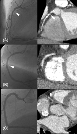 Figure 2 Typical examples of corresponding views by CA (left) and MSCT (right). (A) True-positive MSCT with high-grade stenosis (arrows) of segment 1 visible by both CA and MSCT. (B) False-negative MSCT with high-grade eccentric web-shaped stenosis of segment 2 (arrow), clearly visible by CA but not visible by MSCT. (C) False-positive MSCT with normal CA of RCA. MSCT shows a lesion in segment 2 (arrow), which was interpreted as significant stenosis.