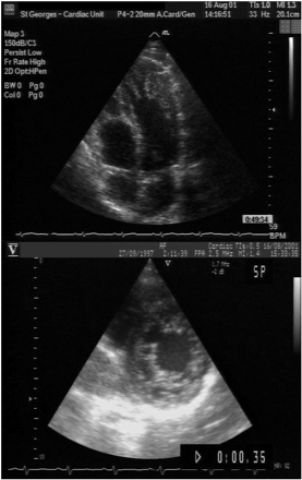 Figure 3 Apical four-chamber view (end-diastole) of a 36-year-old patient (upper) referred with an initial diagnosis of apical hypertrophic cardiomyopathy, with extensive apical trabeculations and recesses consistent with LVNC, and (lower) a parasternal short-axis view (end-diastole) of his asymptomatic 4-year-old son, showing a two-layered structure of compacted and non-compacted endomyocardium. Colour Doppler showed flow between the LV cavity and the recesses.