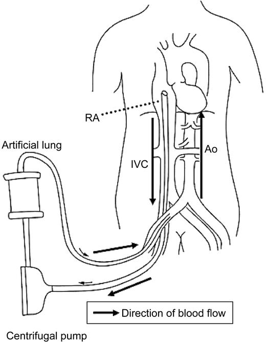 Figure 1 Illustration of ECMO system. RA, right atrium; IVC, inferior venacava; Ao, aorta.