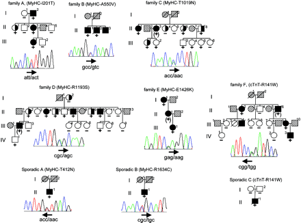 Figure 1 Pedigree drawings of DCM families carrying mutations and sequence electrophoregram representative of each heterozygous mutation. Pedigree symbols: +, heterozygous carrier of mutation; (+), obligate mutation carrier; −, no mutation; filled symbols, DCM affected; open symbol, unaffected subject; half-filled symbol, unknown status; slashed symbol, deceased individuals; hatched symbols, no phenotypical data available. Arrows underlined mutated codon sequences and codon reading orientation.
