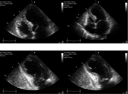 End-diastolic and end-systolic apical four-and-two chamber echocardiographic views demonstrating the typical apical and mid-ventricular LV wall-motion abnormalities of a patient with takotsubo cardiomyopathy diagnosed and managed at the McMaster University in Hamilton, Ontario.
