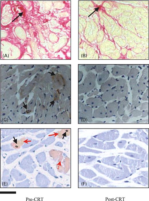 Figure 1 Representative histological images of myocardial tissue sampled before (A, C, and E) and after (B, D, and F) 6 months of CRT. (A) and (B) depict CVF stained with Picrosirius Red method. Black arrows indicate collagen deposition (in magenta or red). (C) and (D) show TNF-α immunoreaction before (pre-CRT) and after (post-CRT) 6 months of CRT, respectively. Note that immunohistochemical signal (brownish cells with black arrows) is present only before CRT. After 6 months, there are no or few scattered cells TNF-α immunopositive. (E) and (F) represent a double reaction for apoptosis detection. Black arrows show apoptotic nuclei marked with DAB by hairpin probe, whereas red arrows show immunoreaction for activated caspase-3, marked in light red by fast red. Note that in (E), there is a cell (red arrow, dotted) immunopositive only for caspase-3. Bar=20 µm.