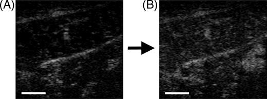 Figure 1 Low-MI B-mode sonography of the calf muscle before (A) and 30 s after infusion of SonoVue (B). Increase of echogenity in muscle tissue is visible but not very distinct. Bar represents 1 cm.