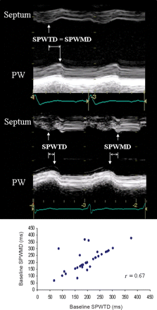 SPWTD vs. SPWMD. Top: in this patient, SPWTD and SPWMD coincide (arrows). Middle: in this case, SPWTD and SPWMD do not coincide (arrows) due to a dissociation between maximal septal thickening and inward endocardial motion. Bottom: correlation between SPWTD and SPWMD. Although in most patients the values of these two parameters coincide, in 10 patients they are different.