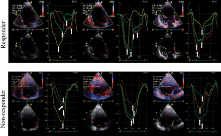 Longitudinal myocardial deformation dyssynchrony illustrated by 12 time-to-peak negative strains (arrows) evaluated in the three standard apical views. In the responder patient, TPS values are disperse indicating a high level of dyssynchrony, whereas in the non-responder, they are very close to each other, indicating a low level of dyssynchrony.